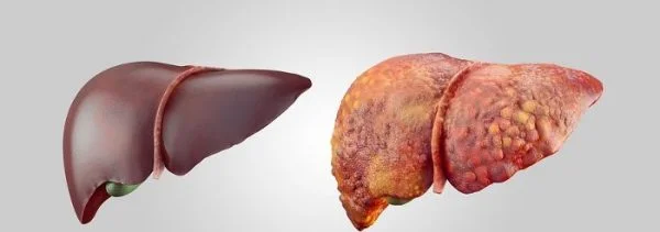 Healthy-liver-and-fatty-liver-600x211